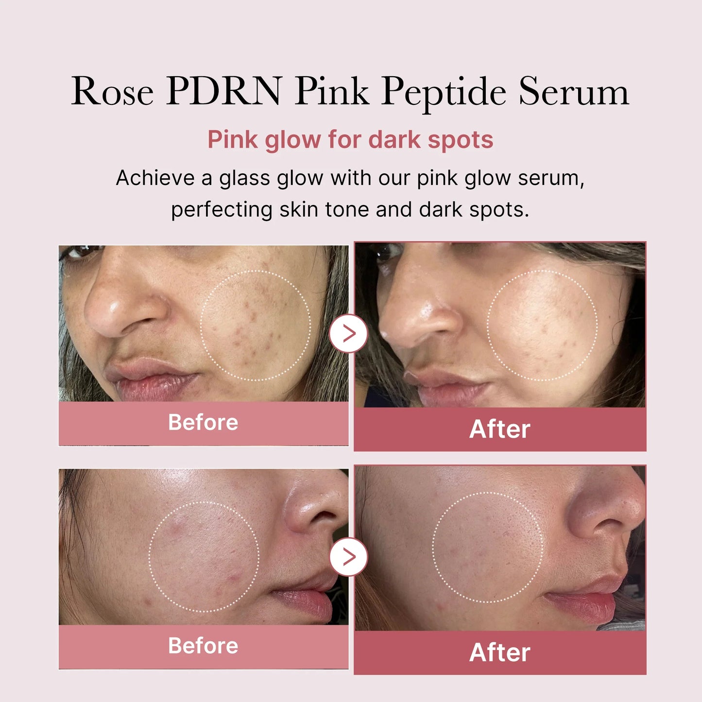 🌷🌺Rose PDRN Repair Serum - Soothe Acne, Strengthen Barrier & Reduce Wrinkles for Clear