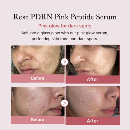 🌷🌺Rose PDRN Repair Serum - Soothe Acne, Strengthen Barrier & Reduce Wrinkles for Clear